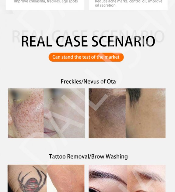 PicoSure Tattoo & Hair Removal picture