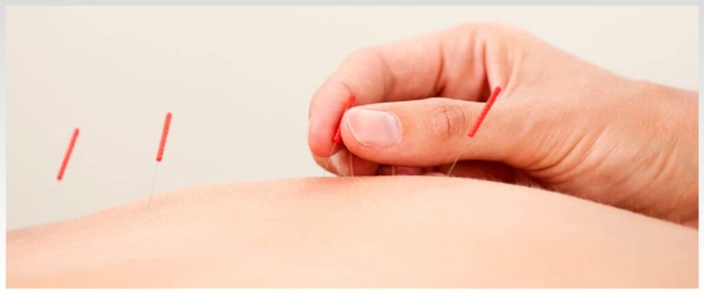 acupuncture-centre-vcare-physio-rehab-1.jpg