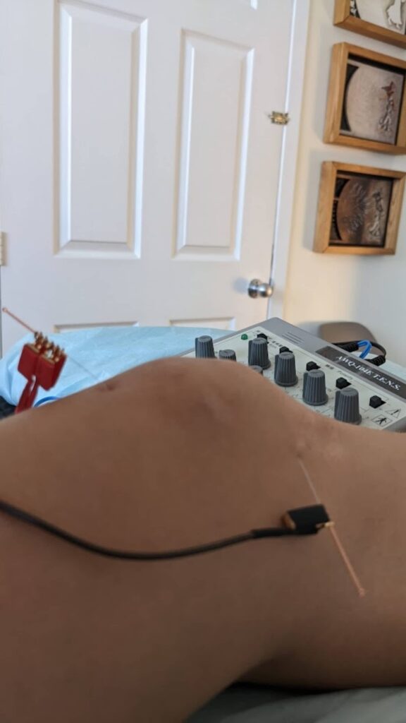 kim-leprohon-acupuncture-1.jpg